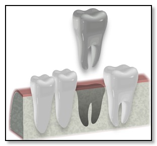 Extraction of damaged tooth