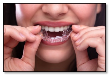 Nightguard bruxism dental retainer